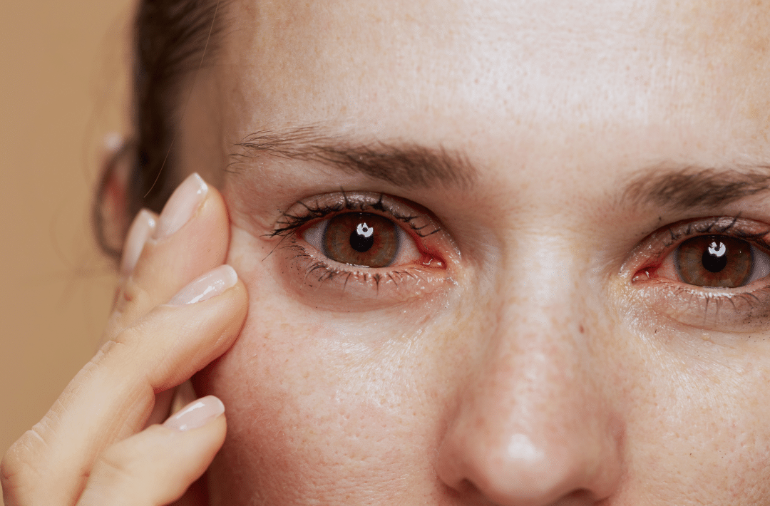 Understanding Dry Eyes